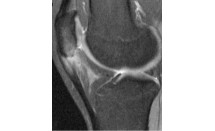Tendinopathie patellaire proximale (Jumper's knee)