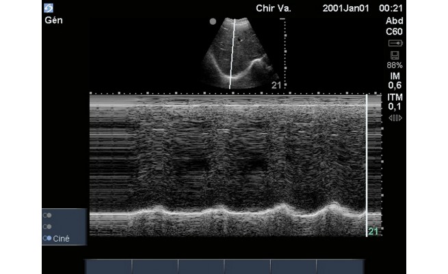 Ks L Echographie Musculaire Pour Le Kinesitherapeute Respiratoire