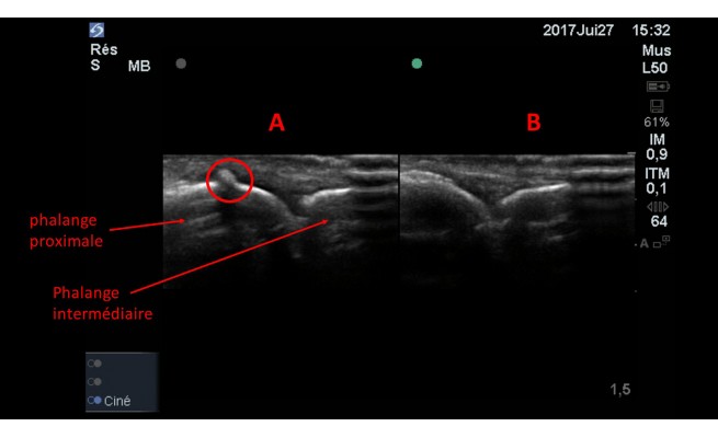 Ks L Echographie Valeur Diagnostique Pour La Detection D Une Fracture Osseuse