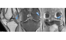 Rupture du ligament croisé postérieur et du ligament fibulaire collatéral