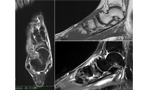 Maladie de Müller-Weiss ostéonécrose aseptique de l'os naviculaire