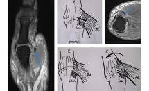 Rupture du ligament collatéral ulnaire de la MCP du pouce Lésion de Stener