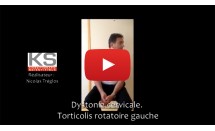 Dystonie cervicale torticolis rotatoire gauche